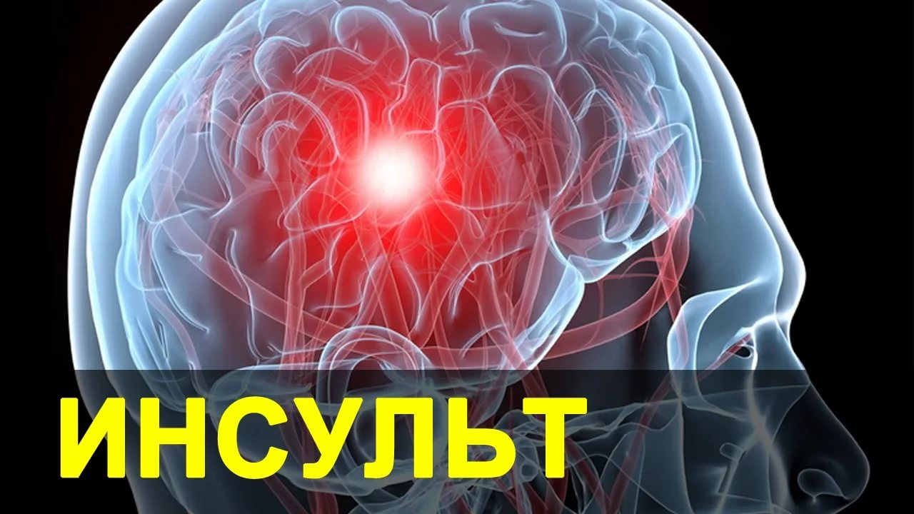 Памятка о первых признаках инстульта и его профилактики